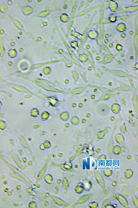 <p>    ↑目前臨床應(yīng)用最廣泛的細(xì)胞生物治療是C IK細(xì)胞治療，在顯微鏡下可清晰看到D C細(xì)胞(葉片形狀)和C IK細(xì)胞(圓點(diǎn)形狀)。</p>